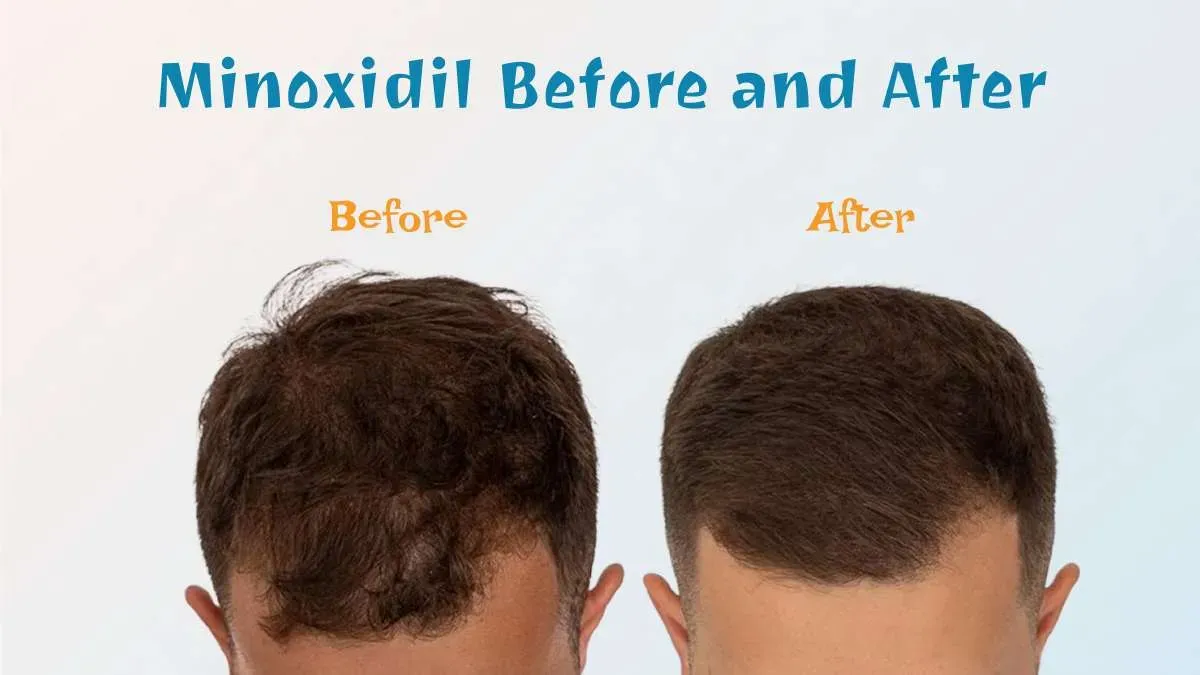 Minoxidil Before and After: Real Results